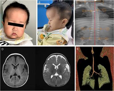 Novel genotypes and phenotypes in Snijders Blok-Campeau syndrome caused by CHD3 mutations